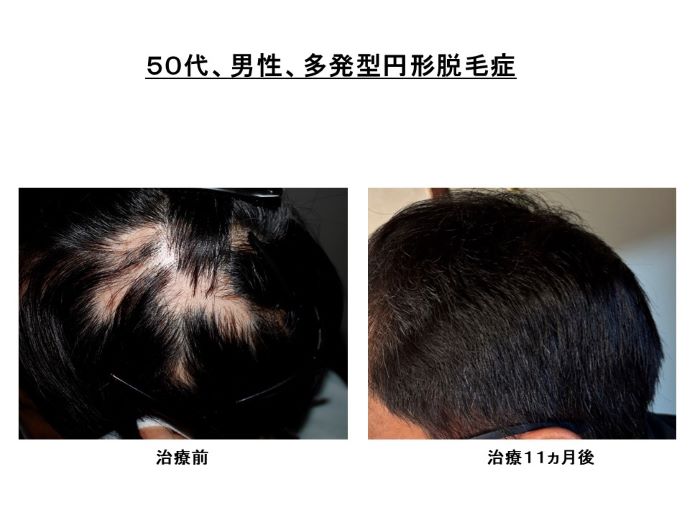 円形脱毛症　病院